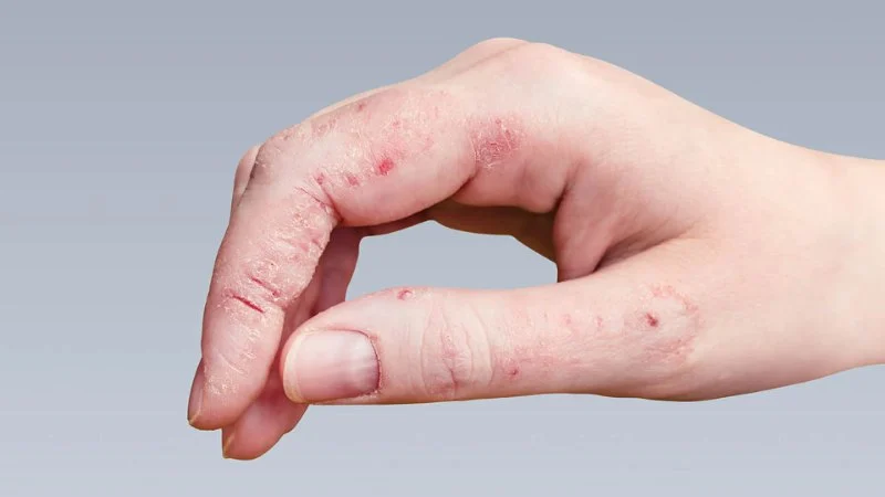 How to Spot and Treat Skin Infections Caused by Fungi or Bacteria