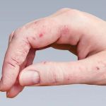 How to Spot and Treat Skin Infections Caused by Fungi or Bacteria