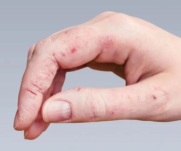 How to Spot and Treat Skin Infections Caused by Fungi or Bacteria