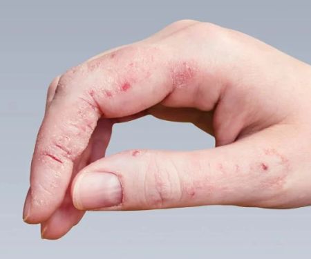 How to Spot and Treat Skin Infections Caused by Fungi or Bacteria